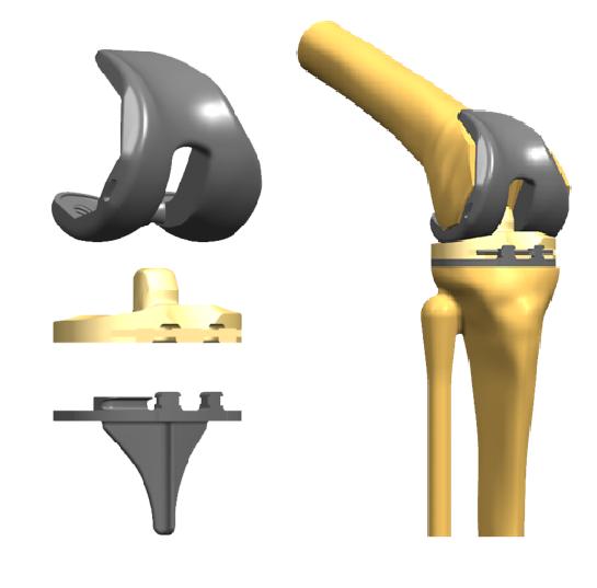 人工膝関節のイラスト。左図真ん中の部分がポリエチレン製のベアリング 